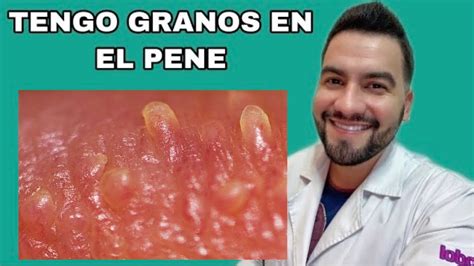 papulas perladas|Pápulas perladas del pene